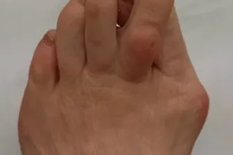 Hallux valgus