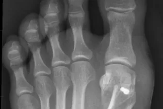 L chevron RTG snímek